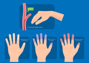 stages cold hands Raynaud's Disease