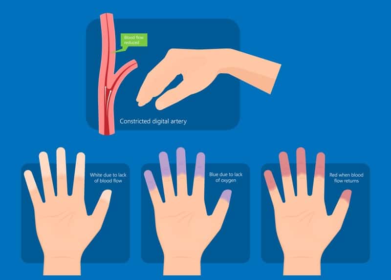 Do you have Raynaud's Disease? Take the self-test!